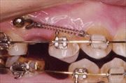 歯列矯正用のインプラント